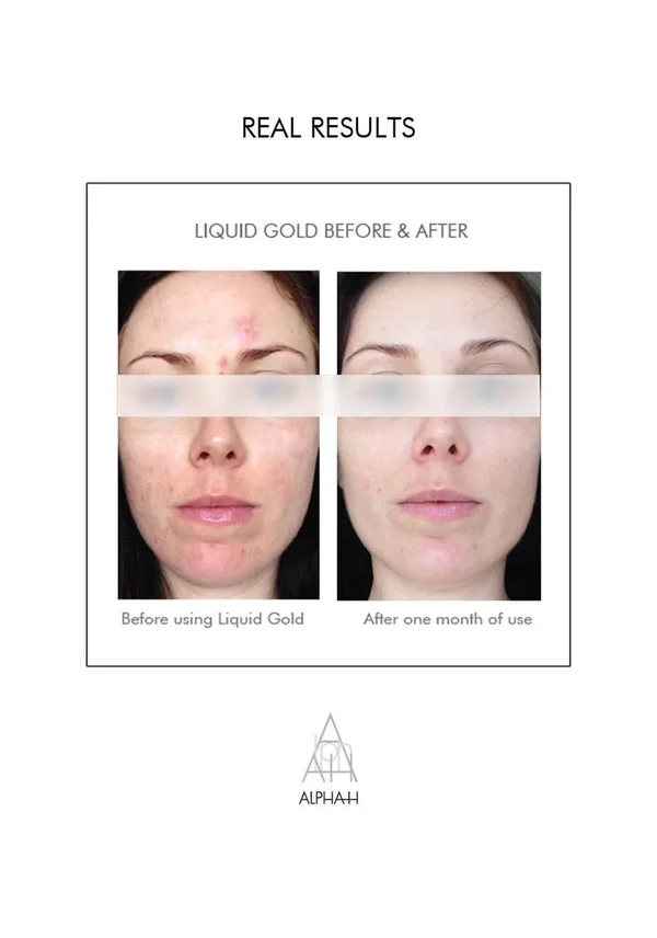 Alpha-H Liquid Gold - Resurfaces Skin Tone Age Spots Acne Scars with Glycolic Acid (100 Milliliters)
